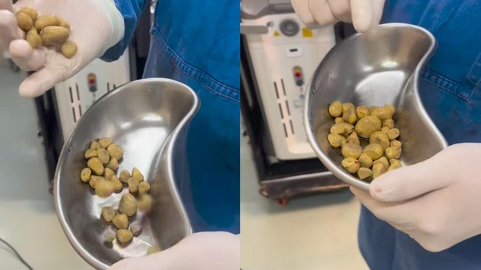 Cerita Dokter Berhasil Keluarkan 35 Batu Ginjal dari Pasien yang Doyan Minum Soda - Update 1