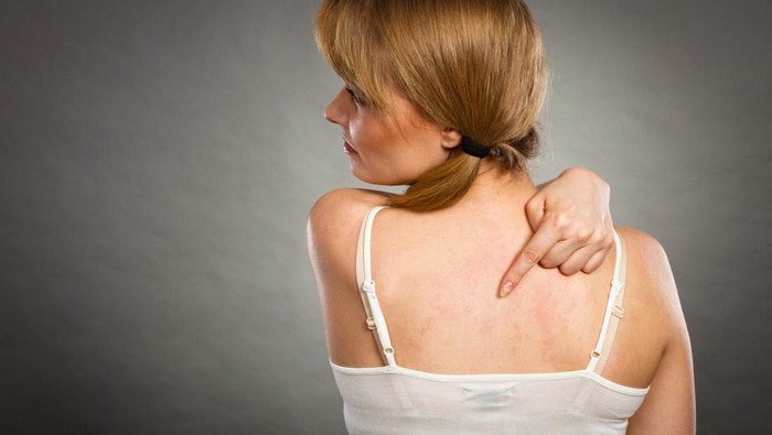 Waspadai! Gejala Mysterious Stevens-Johnson Syndrome yang Mungkin Menyerang Anda Tanpa Diperhatikan