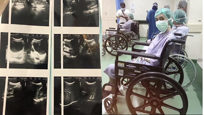 Kanker Usus Muda: Kisah Mengejutkan Wanita 20-an di Jaktim yang Dihantui Nyeri Perut Tak Berhenti