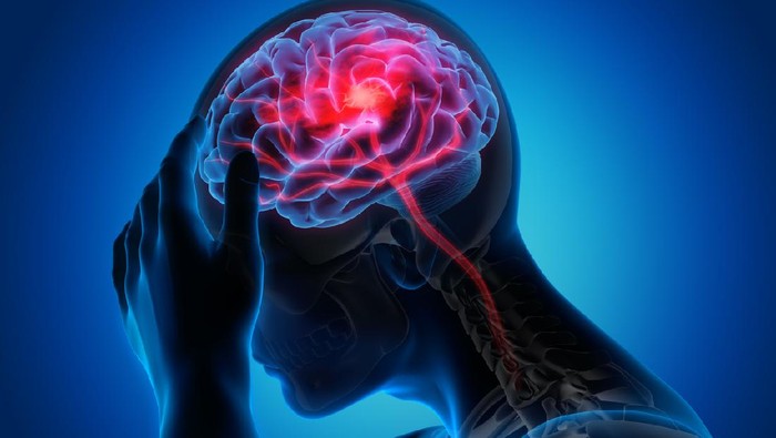 **Waspadalah! 6 Tanda Stroke yang Mungkin Muncul Sebulan Sebelumnya**