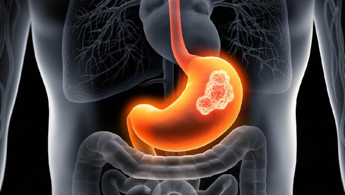 16 Juta Generasi Z-Alpha Diperkirakan Terkena Kanker Lambung, Ini Penyebab dan Pencegahannya