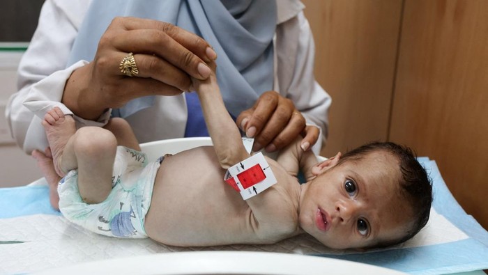 Kondisi Mengenaskan Bayi Malnutrisi di Gaza, Lengannya Cuma Sebesar Ibu Jari - Update 1