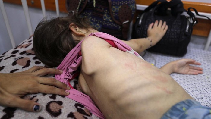 **Dampak Malnutrisi pada Anak di Gaza: Bagaimana Tubuh Menanggapi Kelaparan**