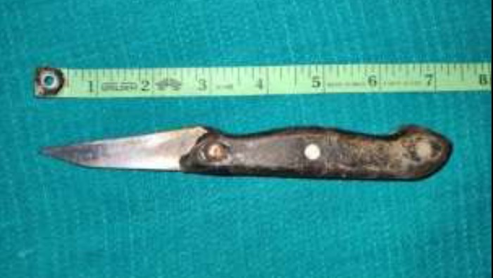 Ngilu! Dokter Temukan Pisau 17 Cm di Usus Pasien, Ternyata Ini Awal Mulanya - Update 1