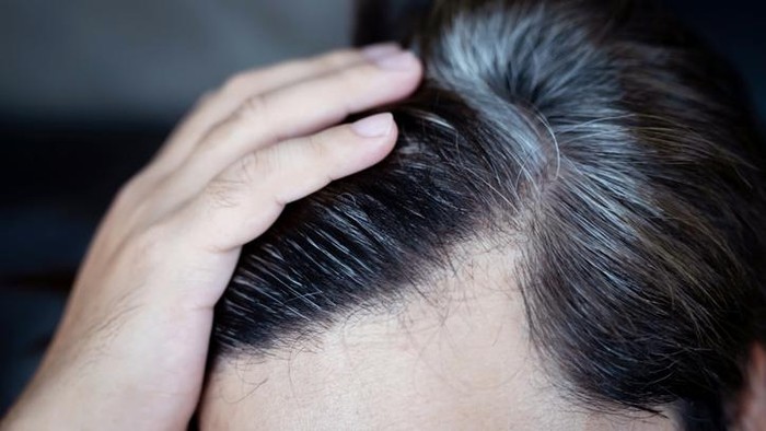 Obat Uban dengan Suntik, Tren Viral di China yang Menjanjikan Rambut Hitam Lagi